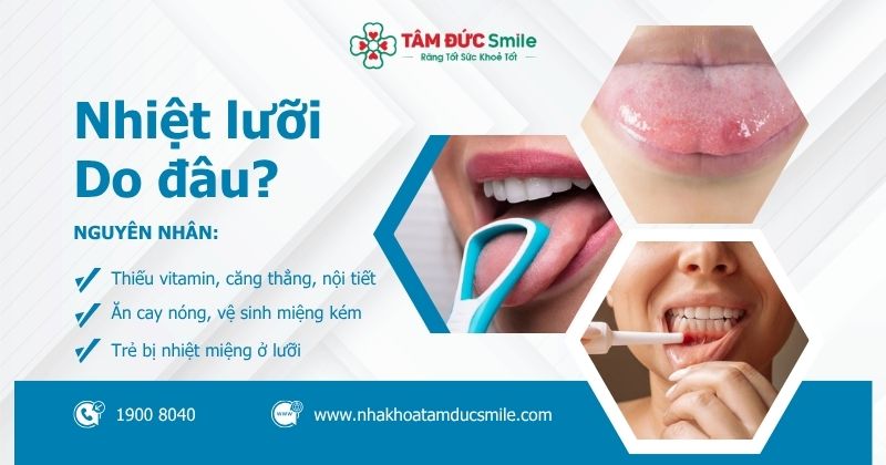 Nhiệt lưỡi, lở loét đau rát: Nguyên nhân, dấu hiệu và cách chữa hiệu quả tại nhà