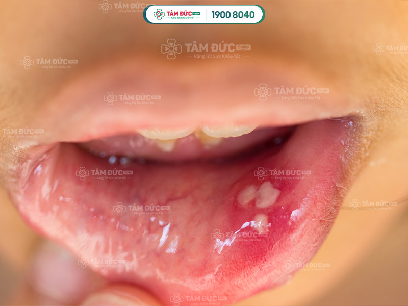 vết loét nhiệt miệng do herpes