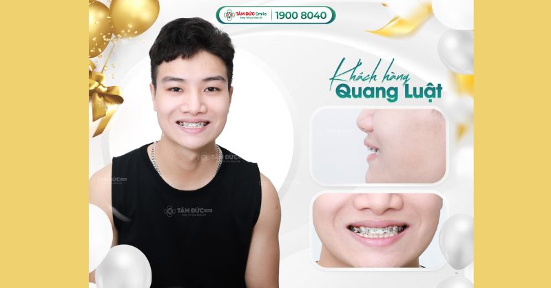Niềng răng 1 hàm trên giá bao nhiêu? So sánh chi phí & hiệu quả tại Tâm Đức Smile