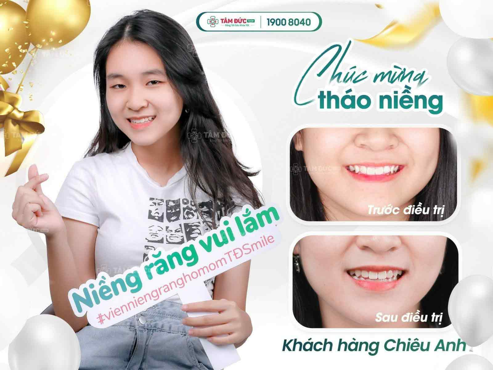 niềng răng không nên ăn gì