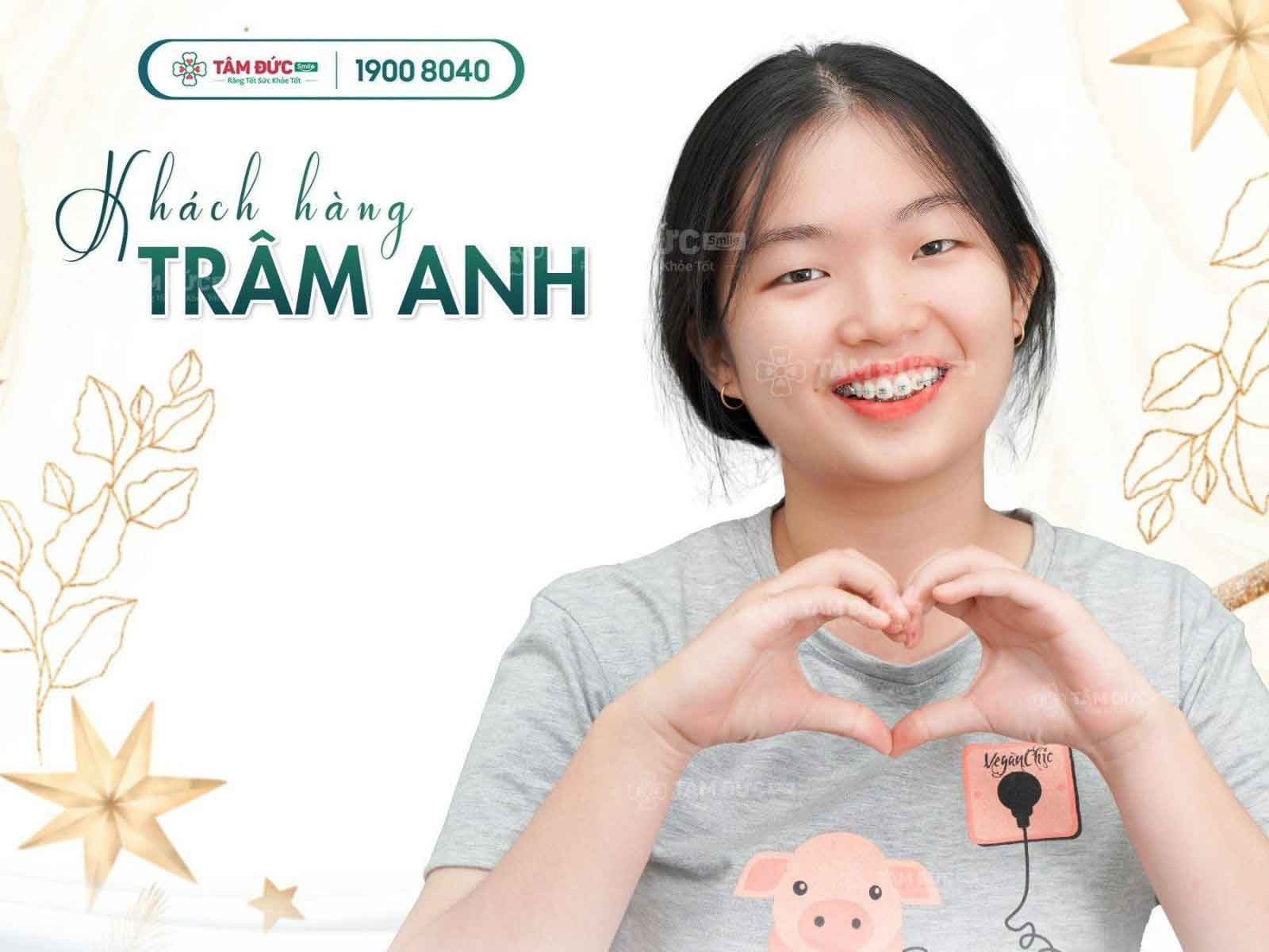 niềng răng thẩm mỹ