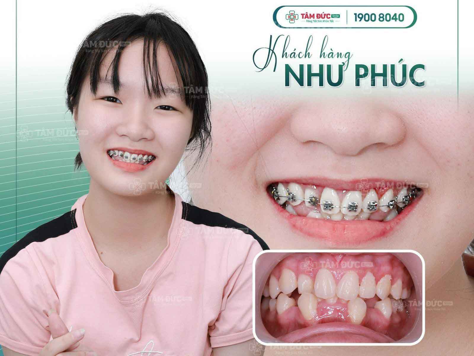 Em Phúc sau khi niềng răng tại nha khoa Tâm Đức Smile