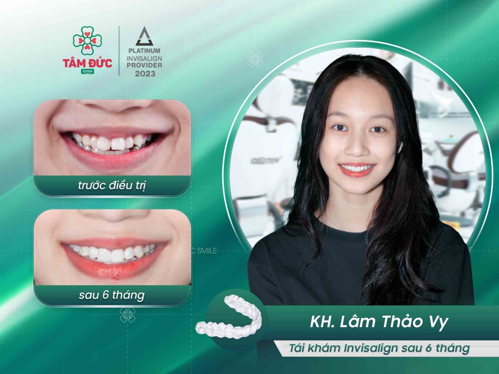 khách hàng niềng răng trong suốt tại nha khoa Tâm Đức Smile