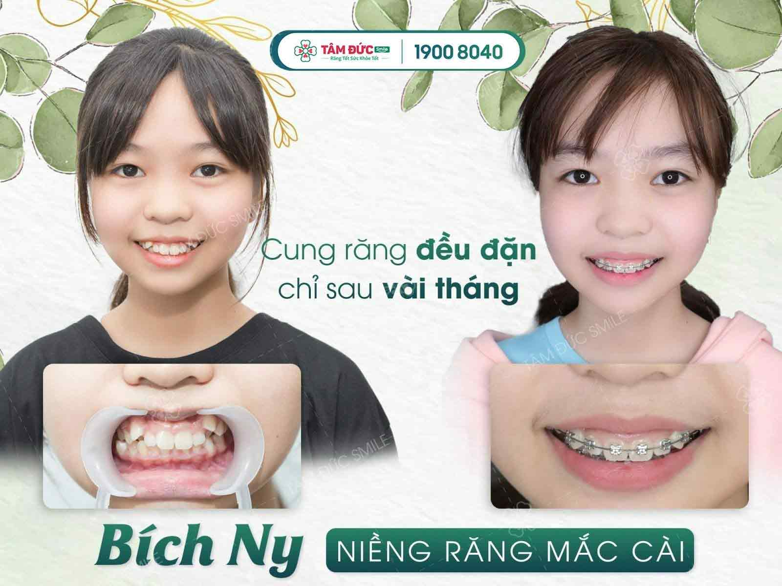 niềng răng cần lưu ý những gì