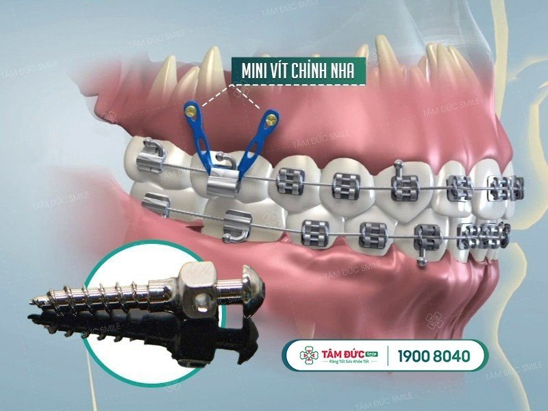 những lưu ý trong niềng răng