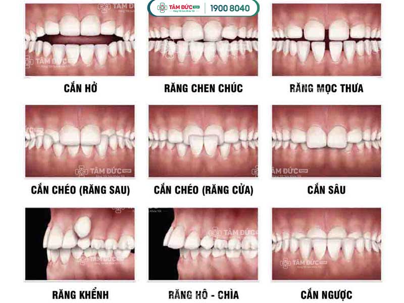 các nguyên nhân làm răng của trẻ mọc lệch