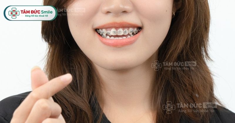 Niềng răng giá bao nhiêu? Bảng giá các loại niềng tại Nha khoa Tâm Đức Smile