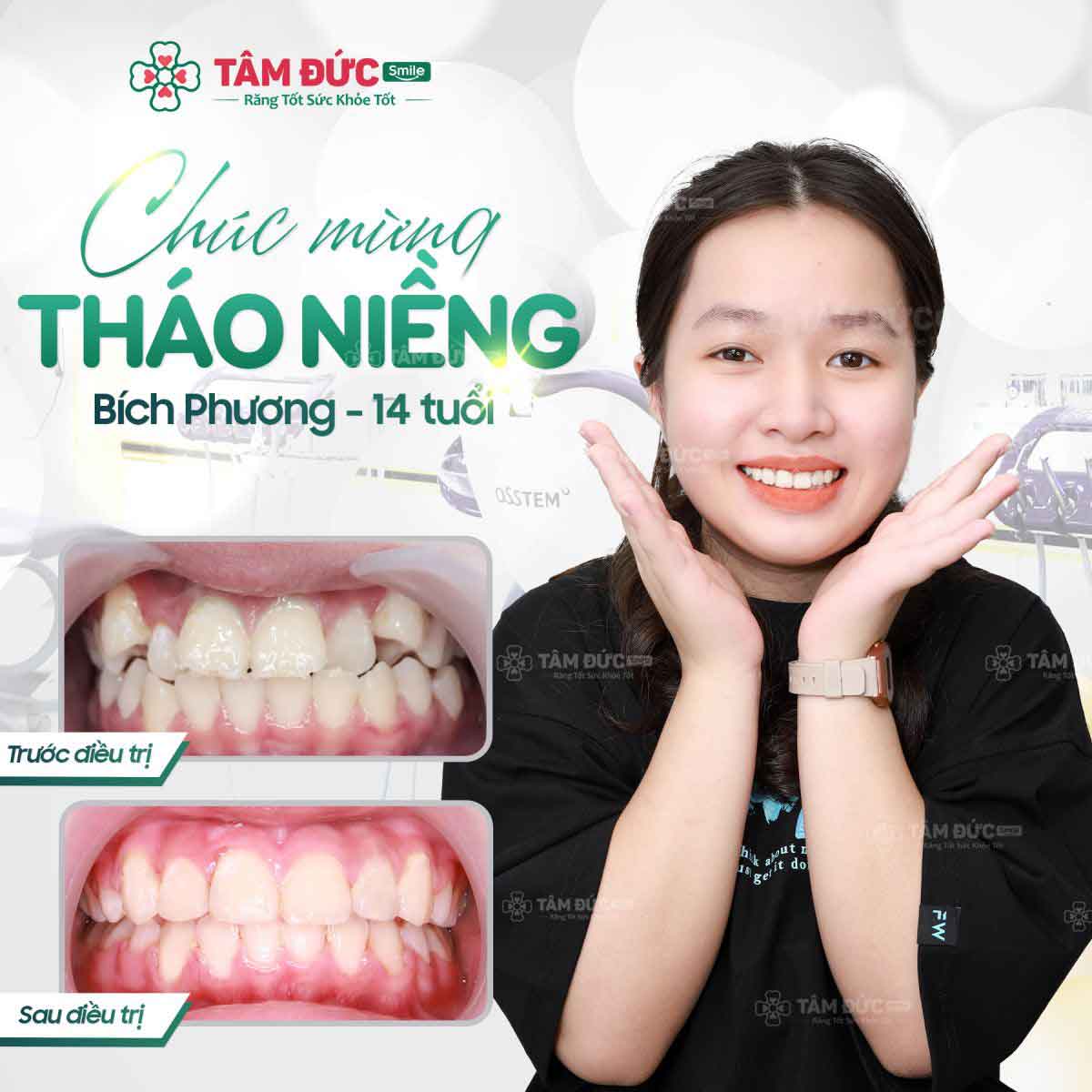 có nên niềng răng khểnh không