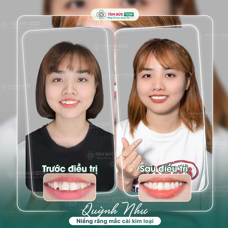 khách hàng niềng răng tại nha khoa Tâm Đức Smile