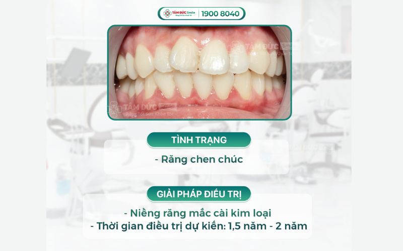 nieng-rang-mac-cai-kim-loai-gia-bao-nhieu-3