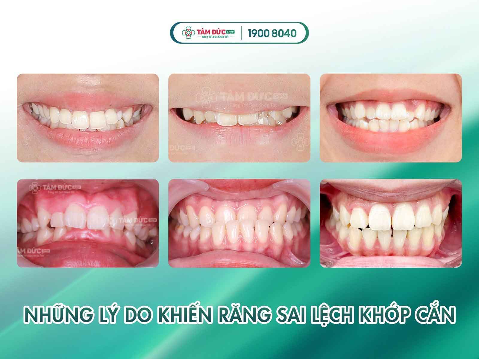 cách khắc phục răng mọc lệch