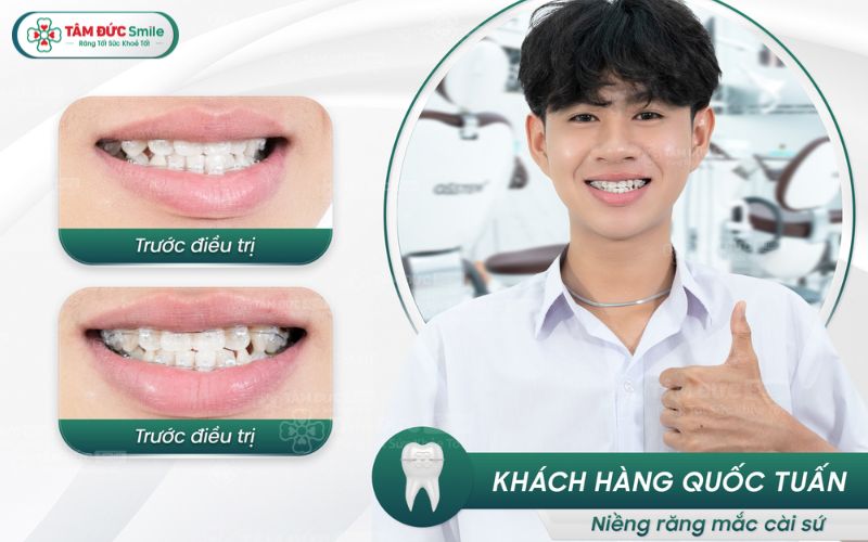 nieng-rang-mom-gia-bao-nhieu-6