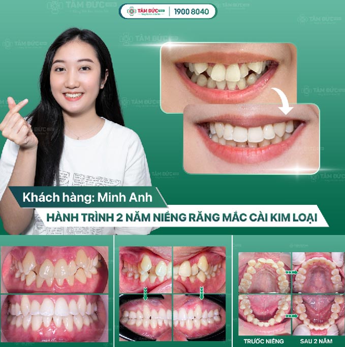 thời gian niềng răng trong bao lâu tuỳ vào độ tuổi của Quý khách