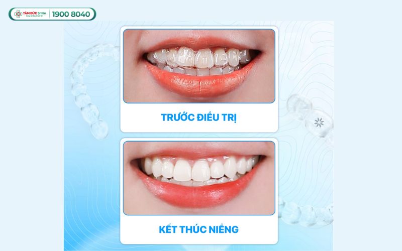nieng-rang-trong-suot-gia-bao-nhieu-2