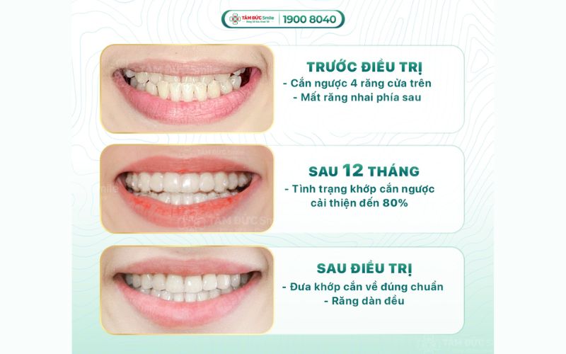 nieng-rang-trong-suot-gia-bao-nhieu-3