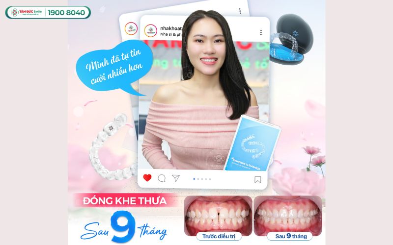 nieng-rang-trong-suot-gia-bao-nhieu-7