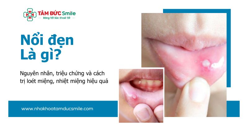 Nổi đẹn: Nguyên nhân, triệu chứng và cách trị loét miệng, nhiệt miệng hiệu quả