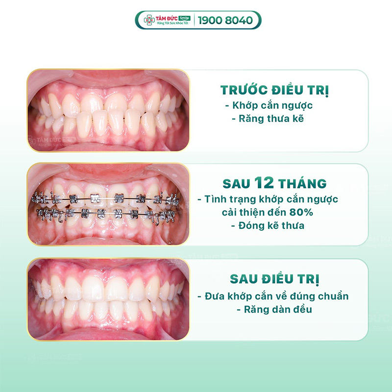 hình ảnh trước và sau khi niềng răng