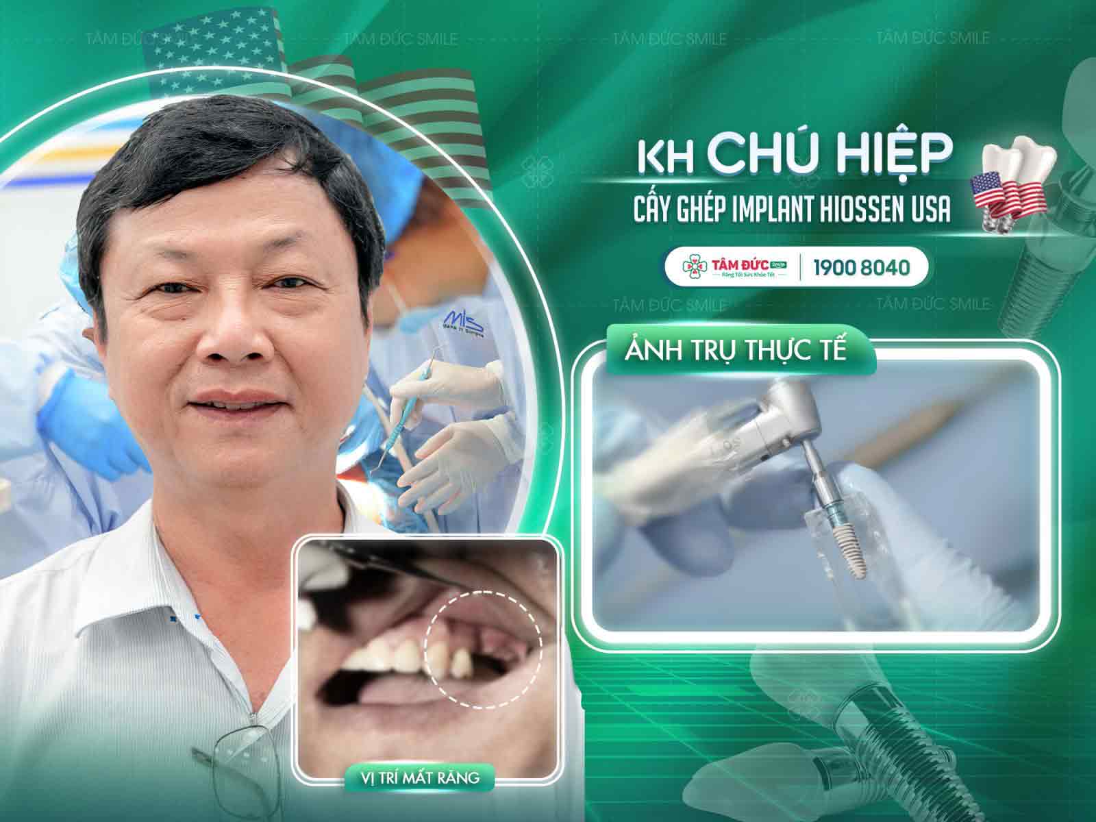 Phẫu thuật ghép xương hàm trước trồng implant