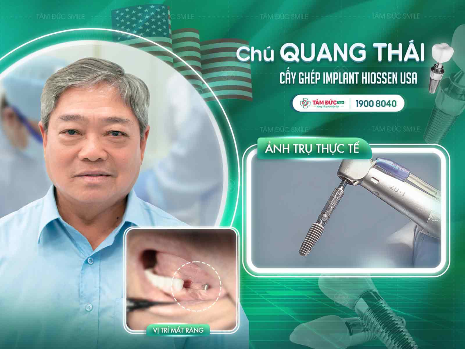 phẫu thuật ghép xương