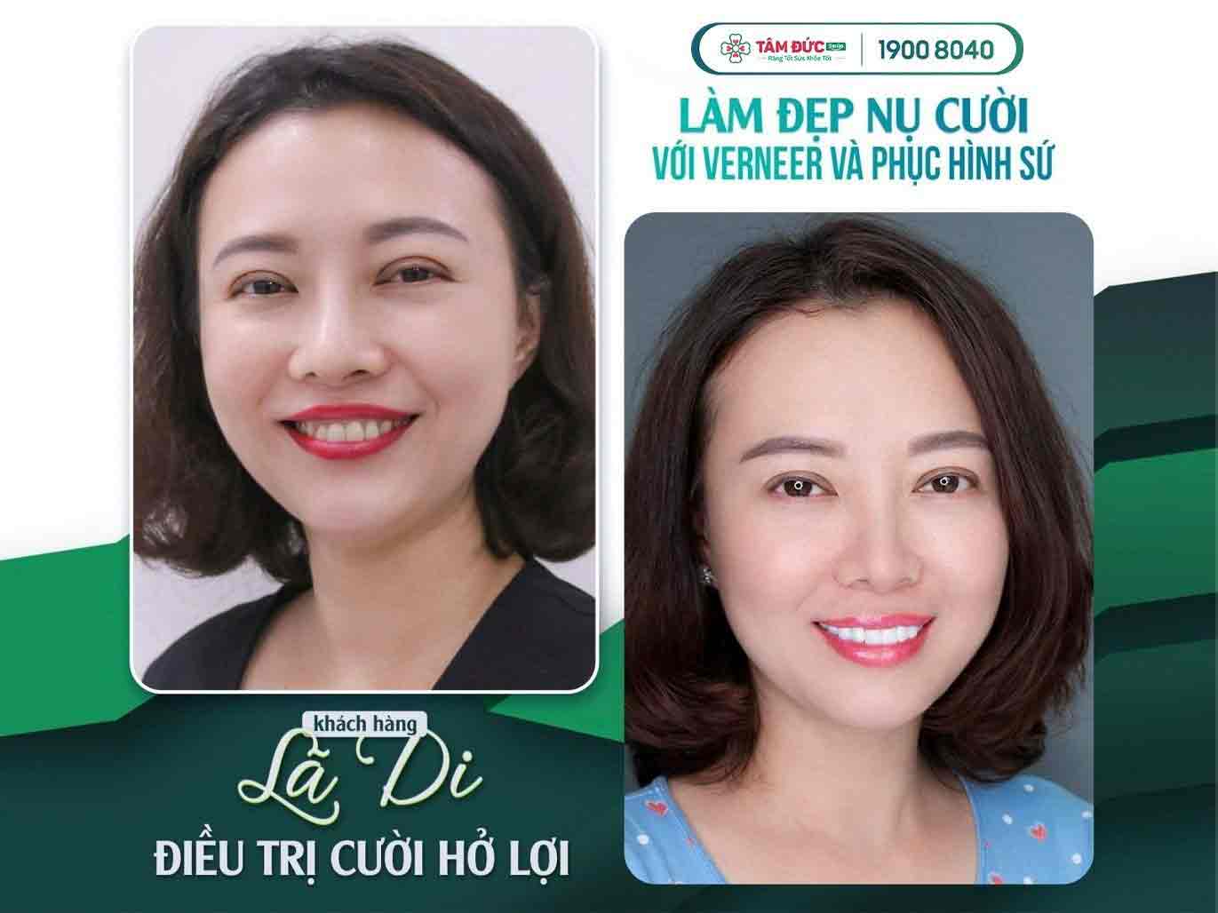 Chị Di sau khi điều trị cười hở lợi