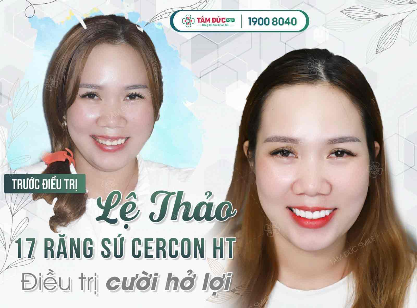 phẫu thuật nướu điều trị cười hở lợi tại nha khoa Tâm Đức Smile