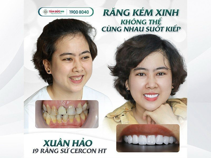 phẫu thuật nướu và điều trị cười hở lợi