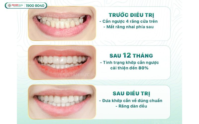 phuong-phap-nieng-rang-10