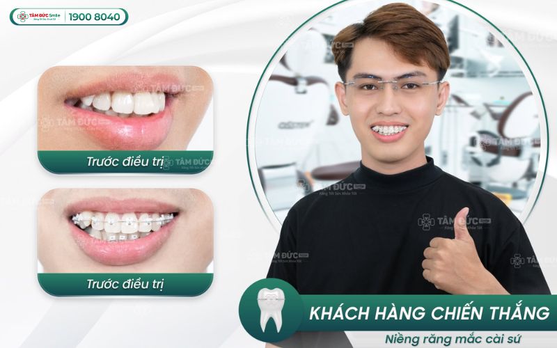 phuong-phap-nieng-rang-3
