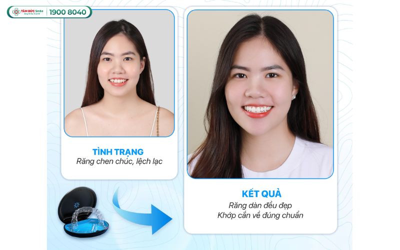 phuong-phap-nieng-rang-4