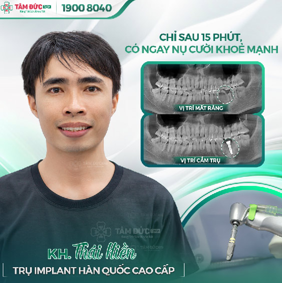 khách hàng bị mất răng số 6