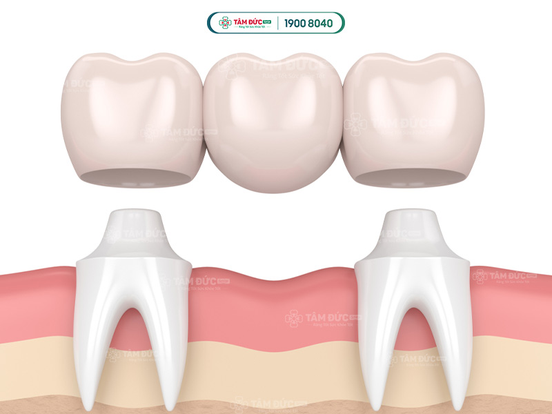 trồng răng hàm bị sâu bằng cầu răng sứ