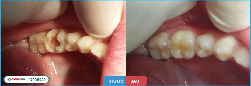 quá trình sâu răng diễn ra như thế nào