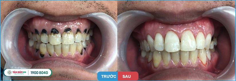 răng bị sâu sau khi được trám thẩm mỹ