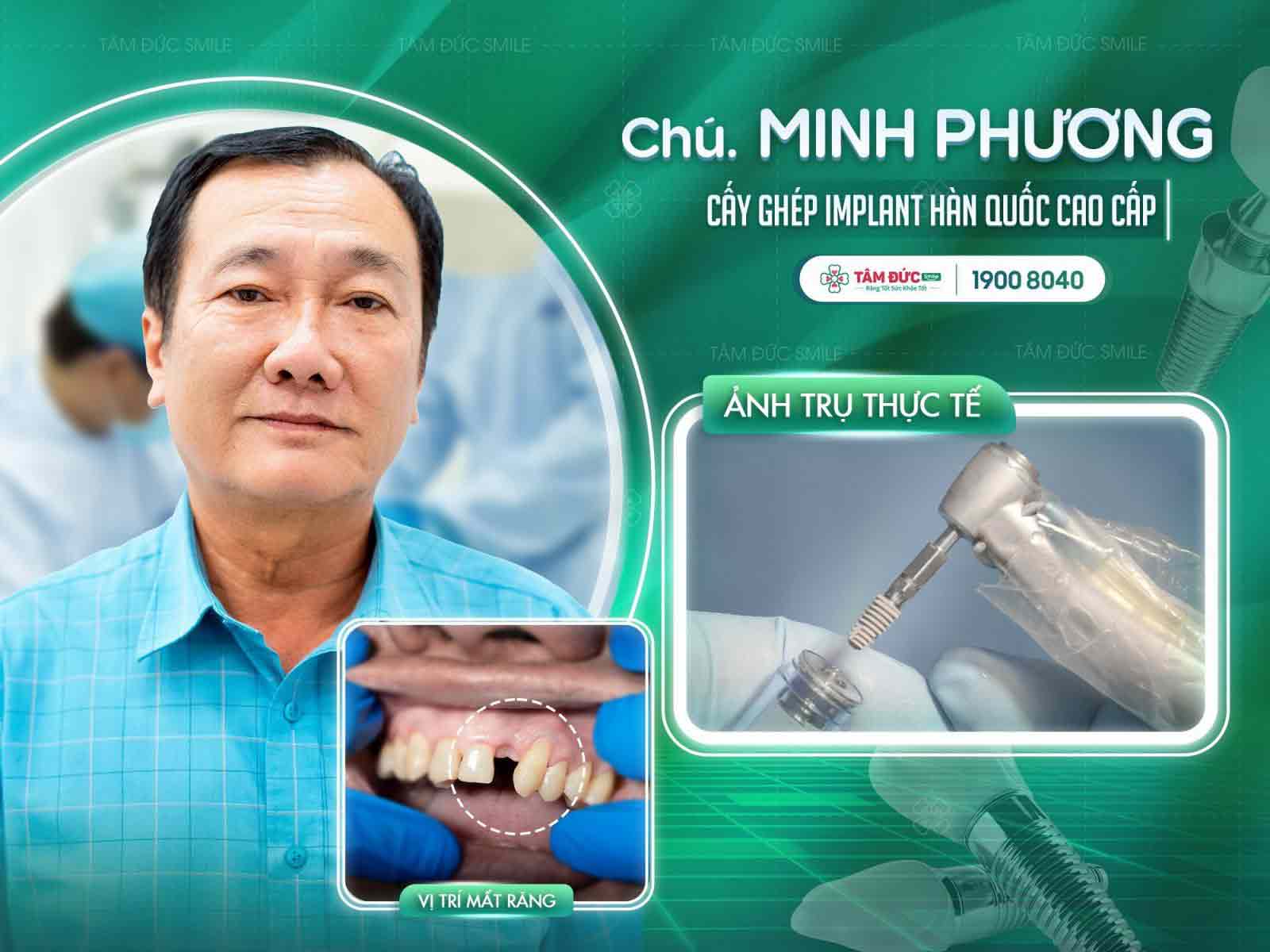 chú Minh Phương cắm Implant sau khi răng bị sâu ăn mòn hết