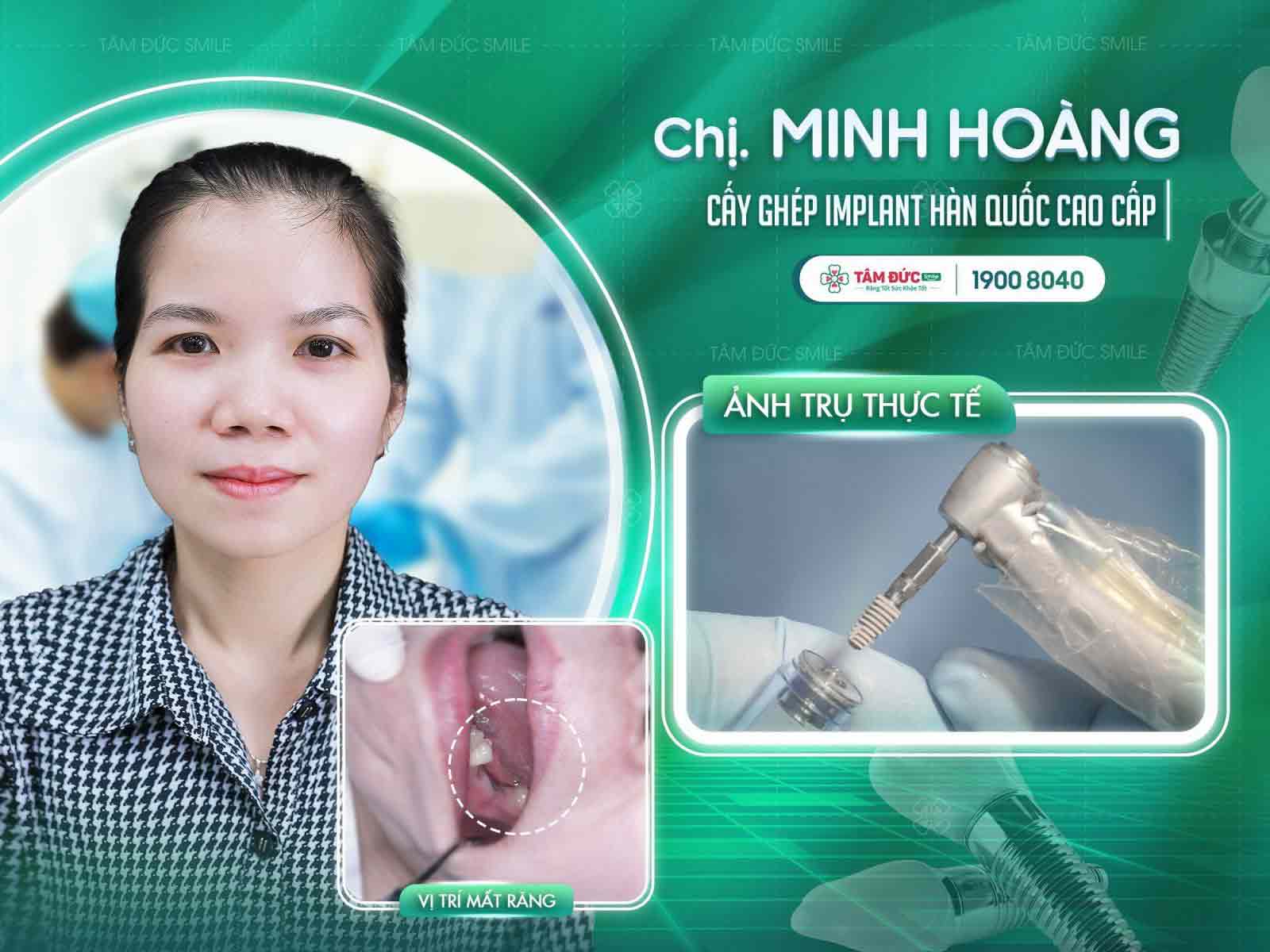 chị Minh Hoàng sau khi cấy Implant tại nha khoa Tâm Đức Smile