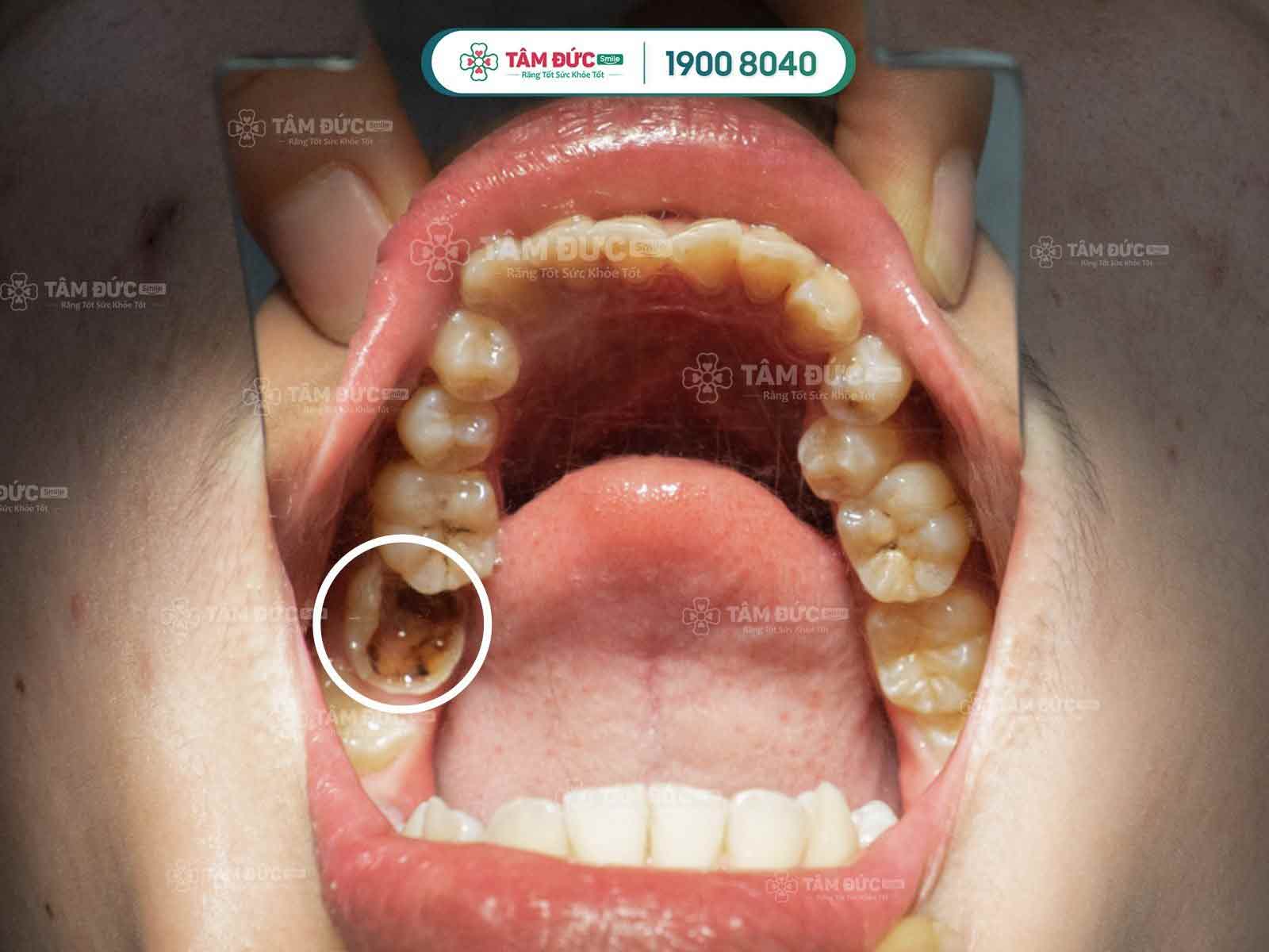 Răng bị sâu trám có đau không