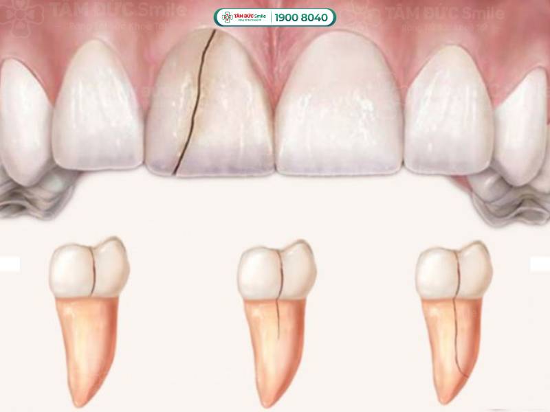 răng bị vỡ dọc làm sao để lành lại? cách cứu răng vỡ dọc hiệu quả