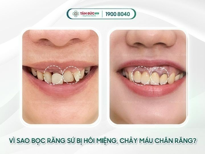 Răng bọc sứ bị viêm tuỷ phải làm sao