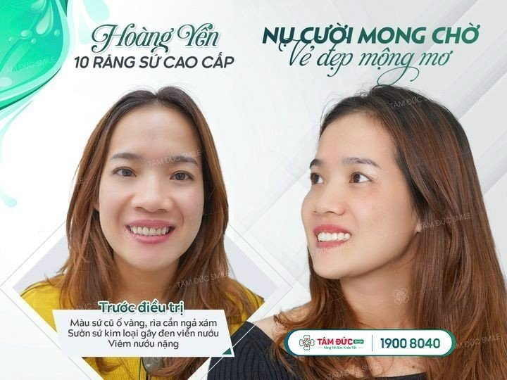 răng bọc sứ bị viêm tuỷ phải làm sao