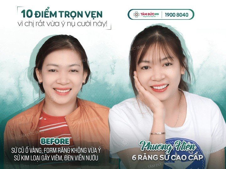 răng bọc sứ bị viêm tuỷ phải làm sao