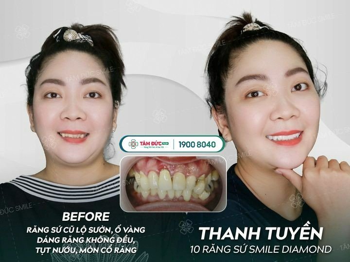 Chị Thanh Tuyền trước và sau khi bọc răng sứ tại nha khoa Tâm Đức Smile