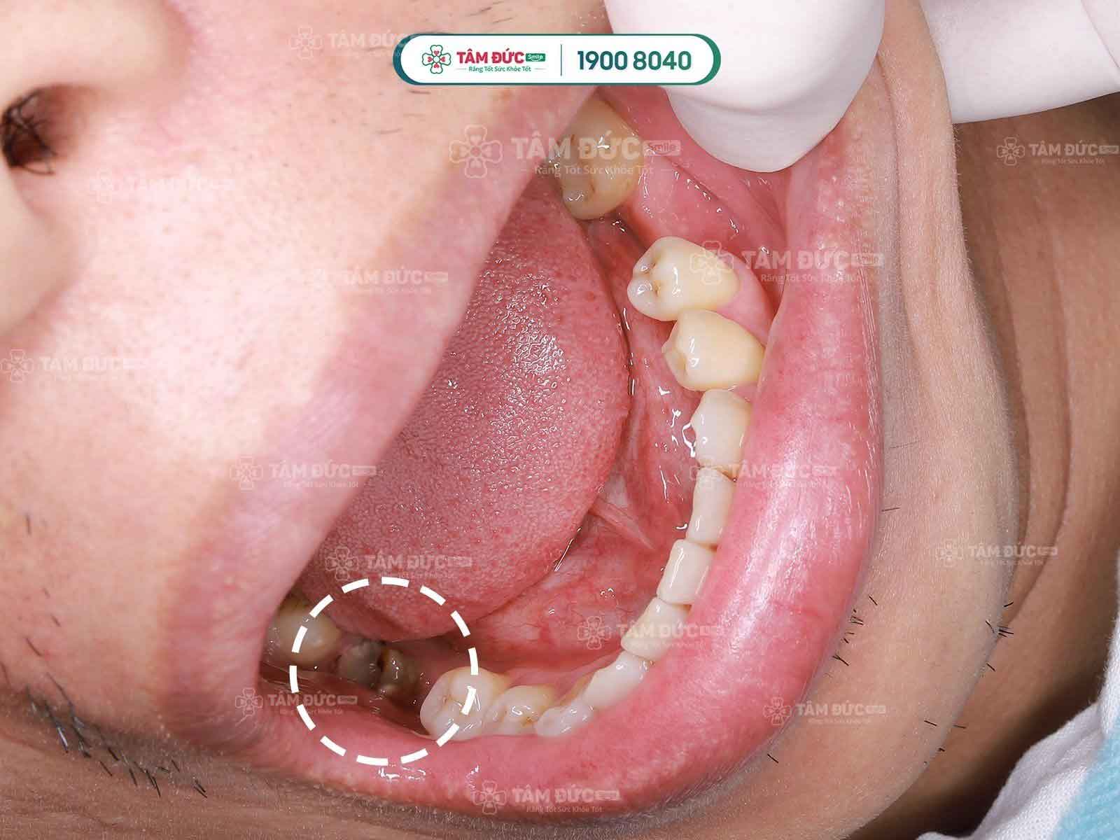 răng hàm bị sâu có nên nhổ không
