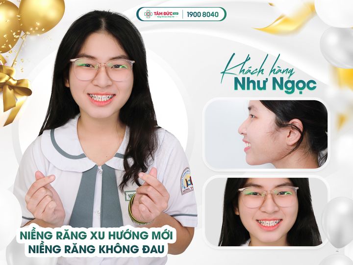 nguyên nhân làm răng bị hô là gì