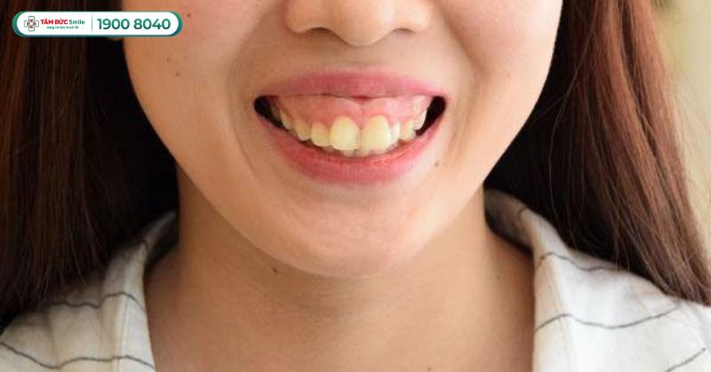 Răng hô: Nguyên nhân, cách điều trị hiệu quả bằng niềng răng, phẫu thuật và bọc sứ