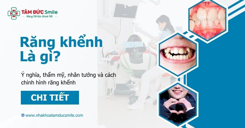 Răng khểnh là gì? Ý nghĩa, thẩm mỹ, nhân tướng và cách chỉnh hình răng khểnh