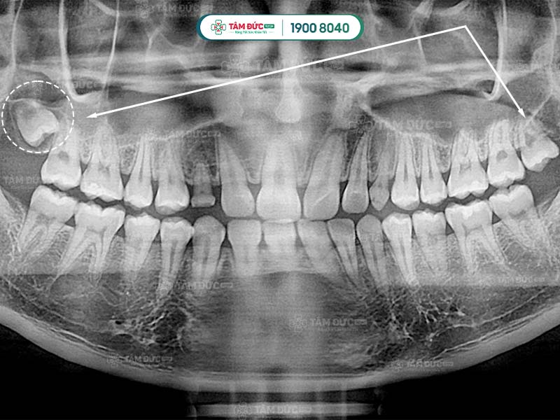 hình phim x-quang răng khôn