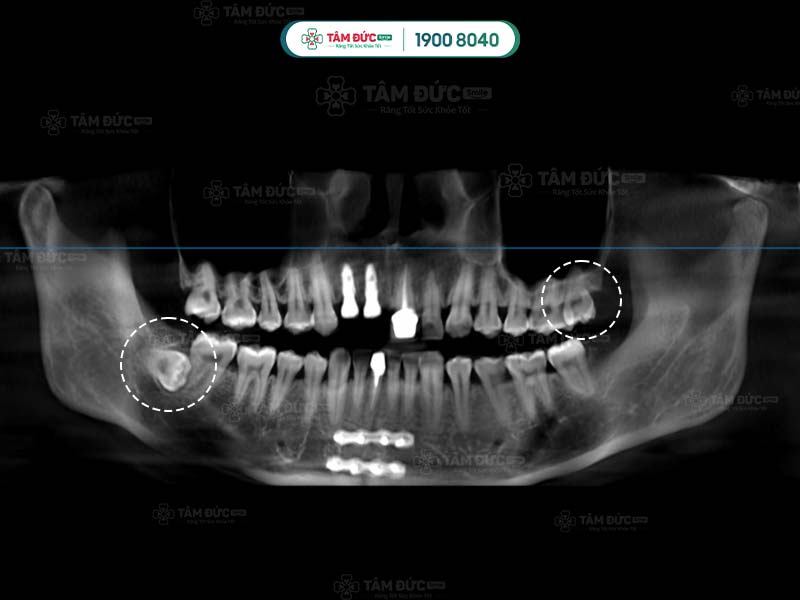 hình phim x-quang giải đáp thắc mắc răng khôn có mấy chân