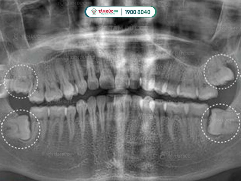 răng khôn có mấy chân