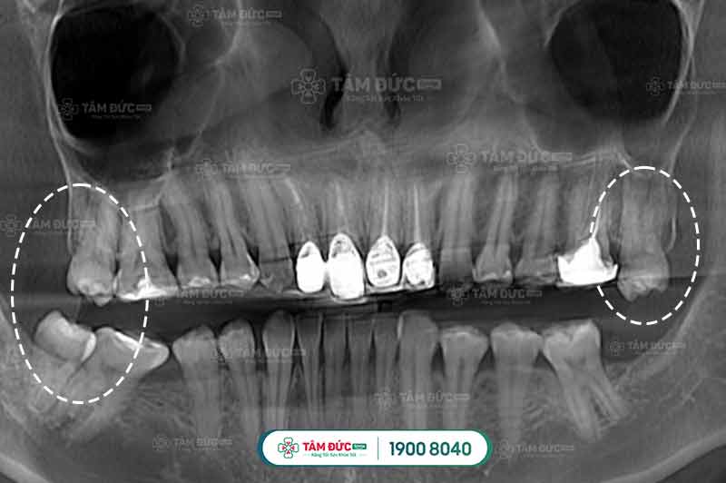 răng khôn đang đau nhổ được không